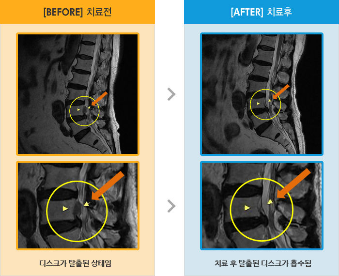 자생한방병원 치료사례 MRI로 보는 치료결과-허리와 왼쪽 다리 통증이 있었고 하루종일 지속
