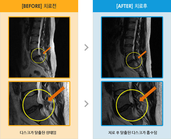 자생한방병원 치료사례 MRI로 보는 치료결과-허리와 왼쪽 다리 통증