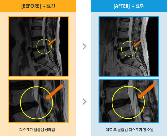 자생한방병원 치료사례 MRI로 보는 치료결과-허리와 오른쪽 다리 통증이 있고 특히 아침에 통증