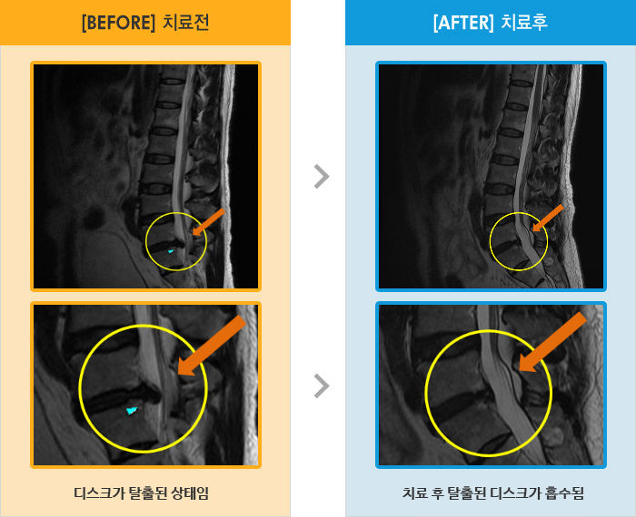 자생한방병원 치료사례 MRI로 보는 치료결과-허리와 왼쪽 다리 통증