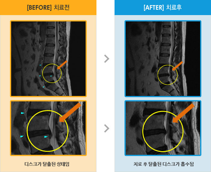 자생한방병원 치료사례 MRI로 보는 치료결과-숙일 때 허리 통증이 있고 간헐적으로 오른쪽 허벅지 찌릿한 느낌