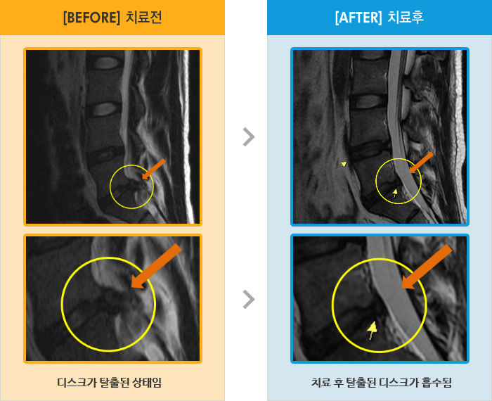 자생한방병원 치료사례 MRI로 보는 치료결과-오른쪽 다리 뒤로 당기는 통증