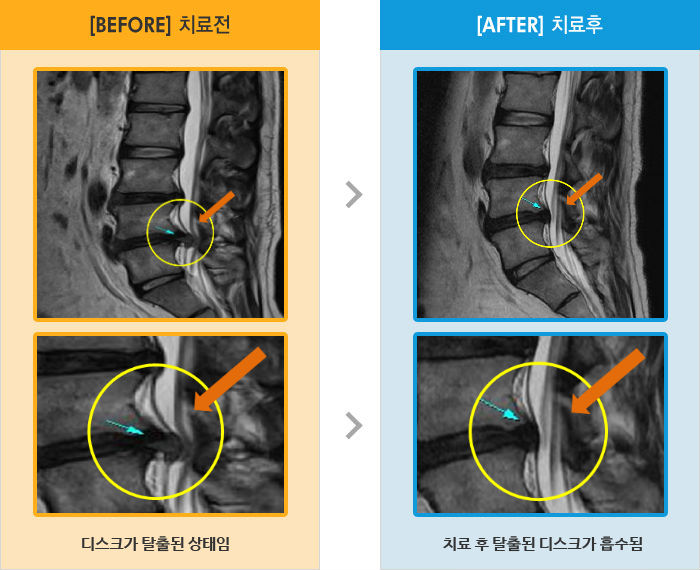 자생한방병원 치료사례 MRI로 보는 치료결과-허리 통증과 왼쪽 다리 저림이 있었고 보행, 좌위시 통증