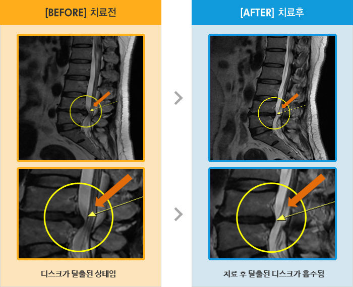 자생한방병원 치료사례 MRI로 보는 치료결과-허리와 왼쪽 엉치에서 종아리까지 당기고 저림