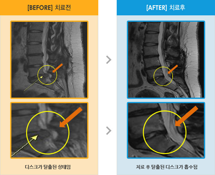 자생한방병원 치료사례 MRI로 보는 치료결과-허리와 오른쪽 다리 통증 및 발 저림