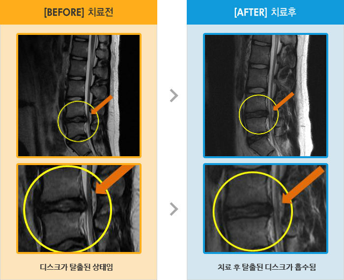 자생한방병원 치료사례 MRI로 보는 치료결과-허리 통증과 왼쪽 다리 저림, 당김