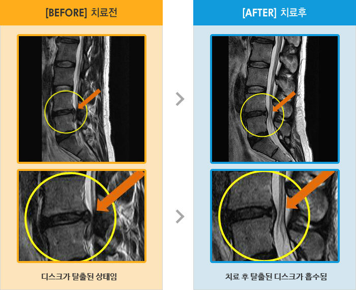 자생한방병원 치료사례 MRI로 보는 치료결과-하지의 저림과 무력감