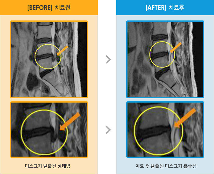 자생한방병원 치료사례 MRI로 보는 치료결과-우측 골반부터 다리 뒤쪽에 통증과 저림