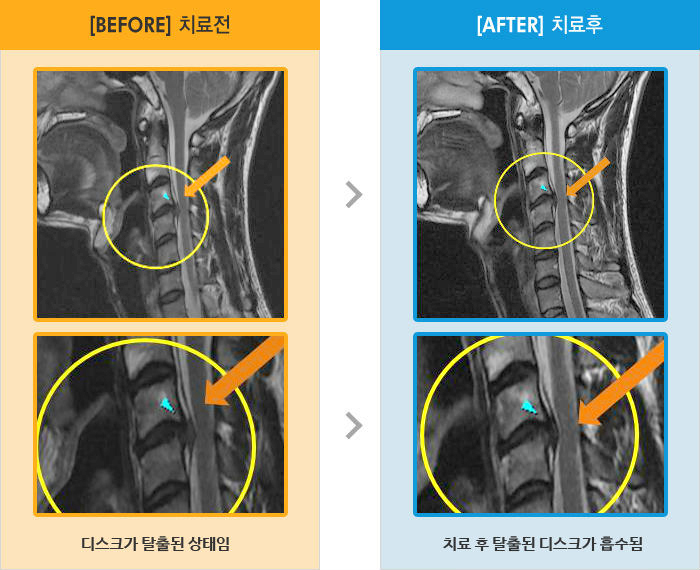 자생한방병원 치료사례 MRI로 보는 치료결과-목뒤 양쪽으로 통증, 목 돌리기가 안됨