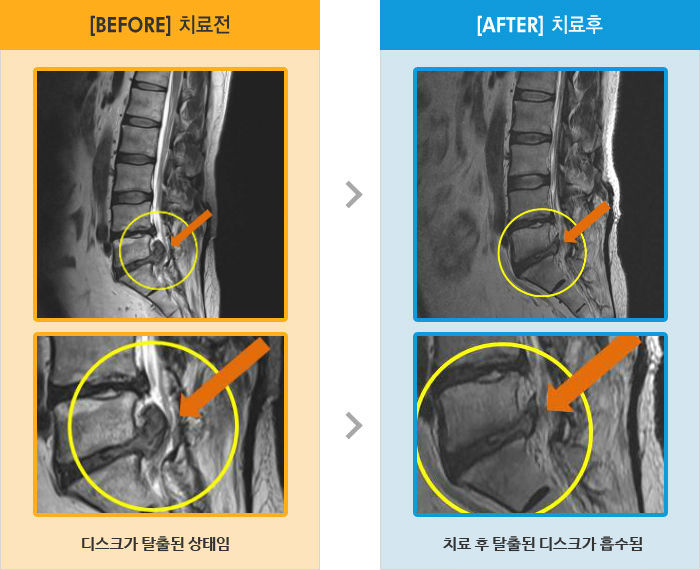 자생한방병원 치료사례 MRI로 보는 치료결과-걸을때 엉덩이 통증