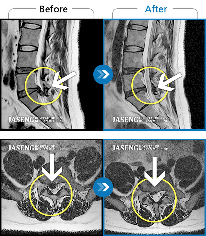 자생한방병원 치료사례 MRI로 보는 치료결과-양쪽 허리와 골반 통증, 걸을 때 우측 다리 당김 및 통증