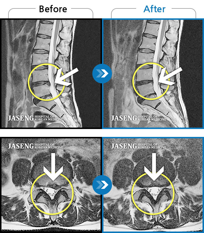 자생한방병원 치료사례 MRI로 보는 치료결과-허리디스크가 흘러내려온 상태로 허리, 골반, 다리가 아파 잠을 못 잘 정도로 통증이 심했습니다. 