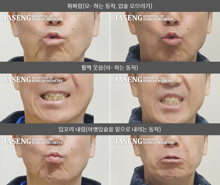 자생한방병원 치료사례 MRI로 보는 치료결과-양치할 때 입에서 물이 새어 놀랐다.