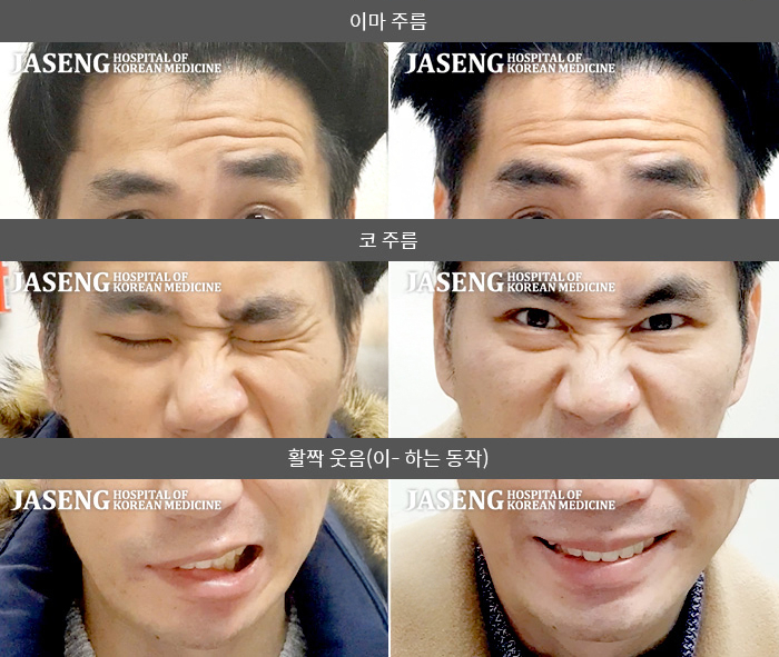 자생한방병원 치료사례 MRI로 보는 치료결과-이마 및 하관 쪽 마비 증상이 심한 상태로 내원하였다.