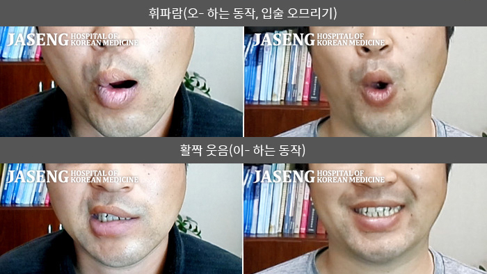 자생한방병원 치료사례 MRI로 보는 치료결과-반대편 얼굴로 재발된 안면마비