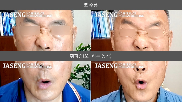 자생한방병원 치료사례 MRI로 보는 치료결과-3주만에 완쾌한 안면마비