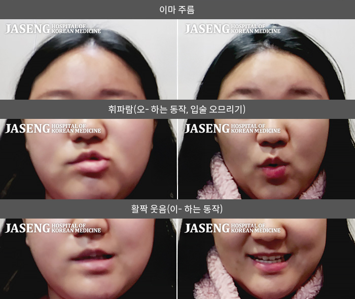 자생한방병원 치료사례 MRI로 보는 치료결과-우측 미각이 소실되고 얼굴에 힘이 안 들어간다