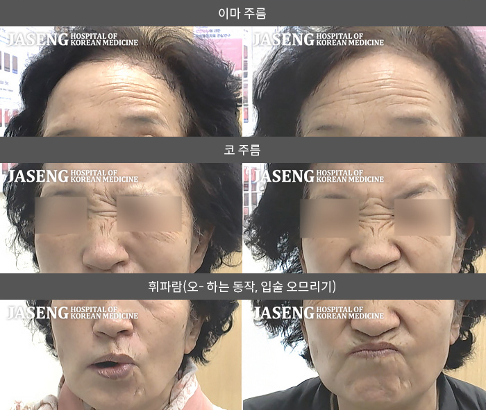 자생한방병원 치료사례 MRI로 보는 치료결과-오른쪽 눈이 안감기고 우측 입이 마비가 되어 왼쪽으로 돌아감 