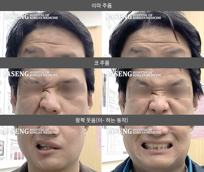 자생한방병원 치료사례 MRI로 보는 치료결과-좌측 눈이 안감기고 좌측 입이 마비되어 입이 우측으로 돌아갔다. 양치 가글 시에는 물이 새었다. 