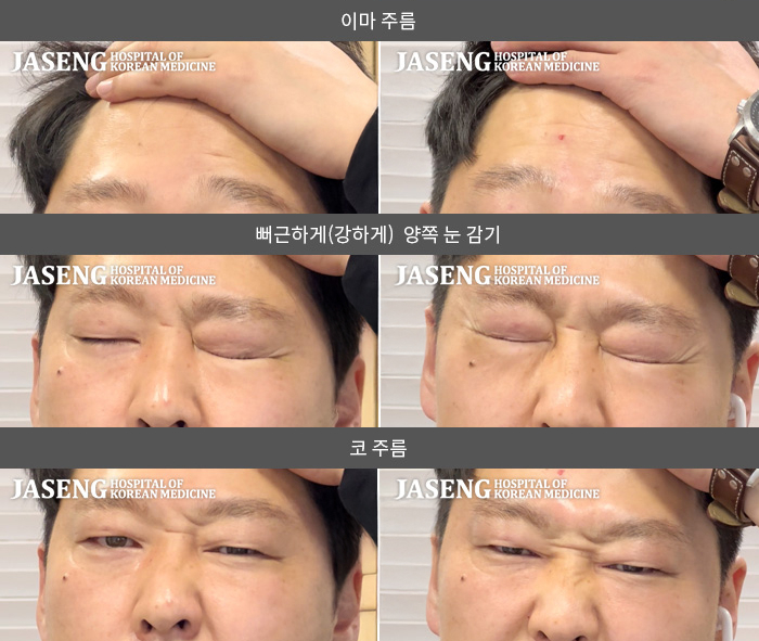 자생한방병원 치료사례 MRI로 보는 치료결과-우측 눈이 감기 힘들고, 혀 감각 소실, 입에 힘을 주면 힘이 안 들어간다.