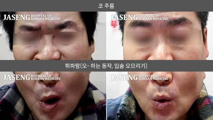 자생한방병원 치료사례 MRI로 보는 치료결과-무리하게 생활한 뒤 생긴 좌측 안면마비