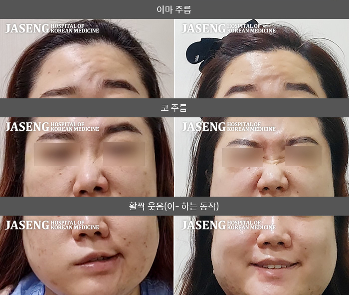 자생한방병원 치료사례 MRI로 보는 치료결과-이내통 및 이후통 동반 되며 이마주름 및 코 주름 불가능한 상태