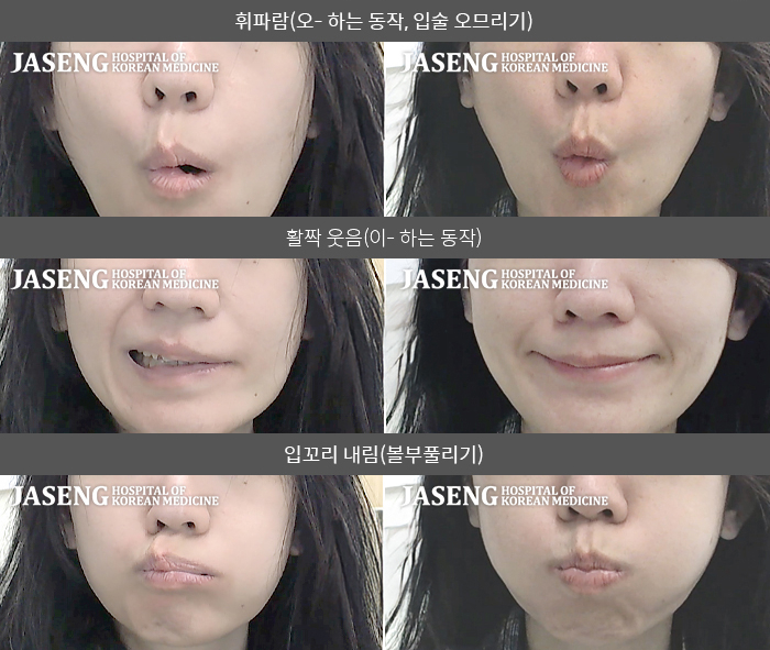 자생한방병원 치료사례 MRI로 보는 치료결과-좌측 눈이 안 감겨서 부자연스럽고 세수할 때 물들어감 . 좌측 입이 마비되어 입이 우측으로 돌아감