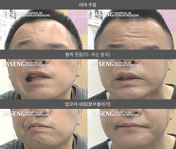 자생한방병원 치료사례 MRI로 보는 치료결과-좌측 입이 마비되어 입이 우측으로 돌아갔습니다. 좌측 눈도 안감겨서 자연스럽지 않고 세수할 때도 물이 들어갔습니다.