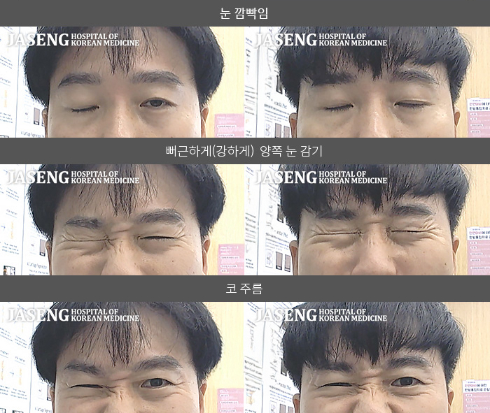 자생한방병원 치료사례 MRI로 보는 치료결과-안면마비 발생 후 양치질 시 입 좌측으로  물이 새면서 좌측안면 마비 인지