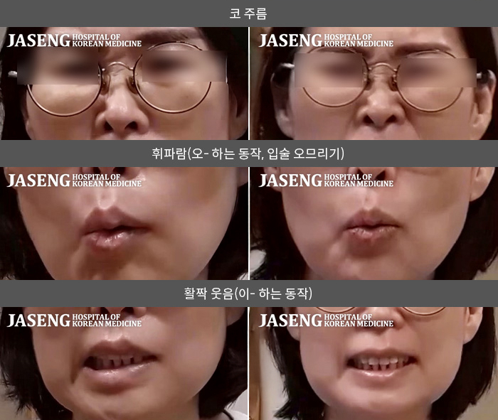 자생한방병원 치료사례 MRI로 보는 치료결과-입 모양이 비대칭이고 물을 마실 때 새요.