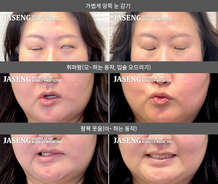 자생한방병원 치료사례 MRI로 보는 치료결과-왼쪽 눈이 잘 안 감기고 왼쪽 안면부 전체 마비된 느낌이다. 