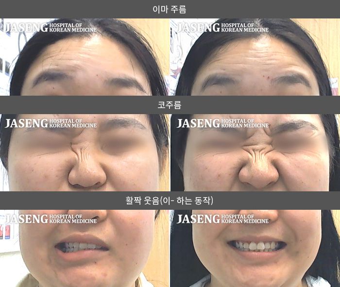 자생한방병원 치료사례 MRI로 보는 치료결과-한국에 유학 온 외국학생으로 시험 준비하면서 과로한 후  안면마비 발생