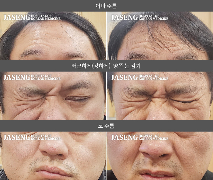 자생한방병원 치료사례 MRI로 보는 치료결과-추운 곳에서 캠핑 후 좌측 안면신경마비 발생하여 이마 주름 불가, 눈 깜박임 불가, 코와 입 부위의 움직임이 현저하게 떨어진 상태로 내원