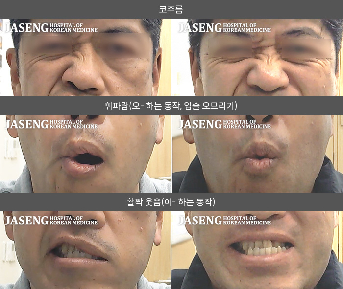 자생한방병원 치료사례 MRI로 보는 치료결과-2025.01.20 좌측안면마비로 내원  좌측 코 주름잡기 좌우비대칭,  입술 오므리기 , 활짝 웃음시 입 모양  좌우비대칭상태로 내원