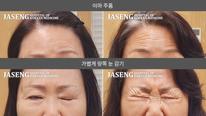 자생한방병원 치료사례 MRI로 보는 치료결과-우측 얼굴 근육이 안 움직이고 눈이 감기지 않았습니다.