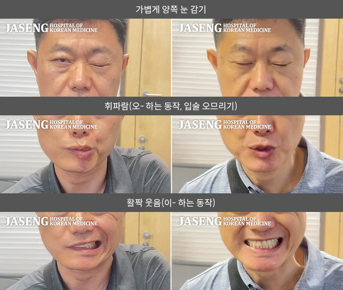 자생한방병원 치료사례 MRI로 보는 치료결과-오른쪽 눈이 잘 안 감기고 오른쪽 안면부 전체가 마비된 느낌이다.