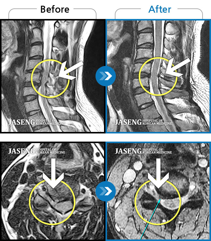 자생한방병원 치료사례 MRI로 보는 치료결과-목 통증 및 우측 팔 통증으로 위로 들 수 없는 상태