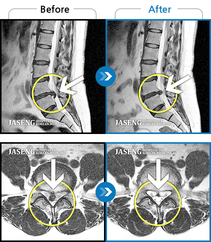 자생한방병원 치료사례 MRI로 보는 치료결과-양측 허리, 우측 엉덩이에서 허벅지 뒤쪽까지 통증