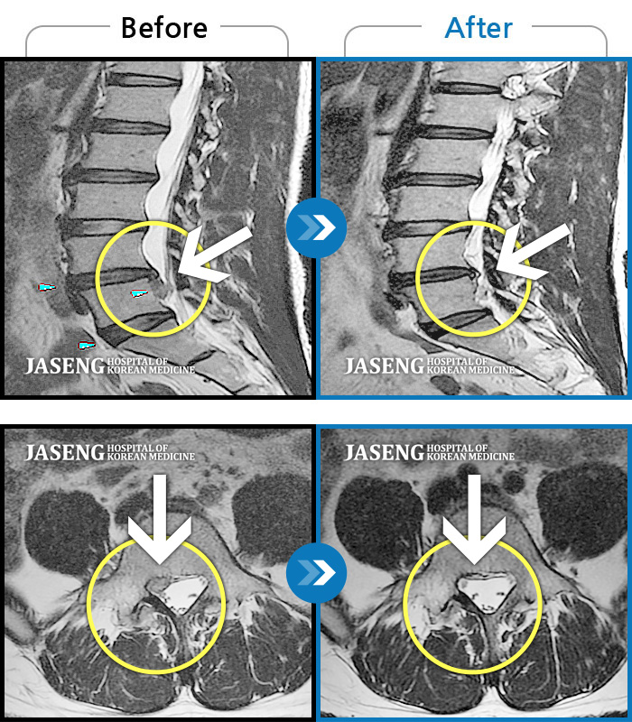 자생한방병원 치료사례 MRI로 보는 치료결과-우측 허리 통증