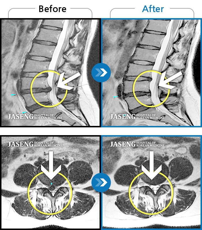 자생한방병원 치료사례 MRI로 보는 치료결과-허리 통증 및 우측 엉치 다리에 통증