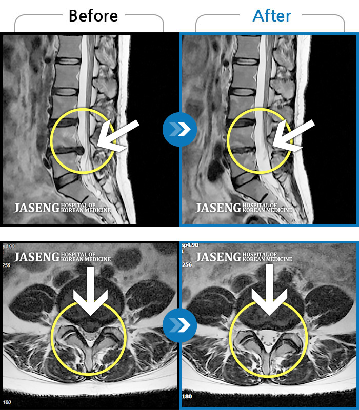 자생한방병원 치료사례 MRI로 보는 치료결과-허리디스크로 인한 골반 통증