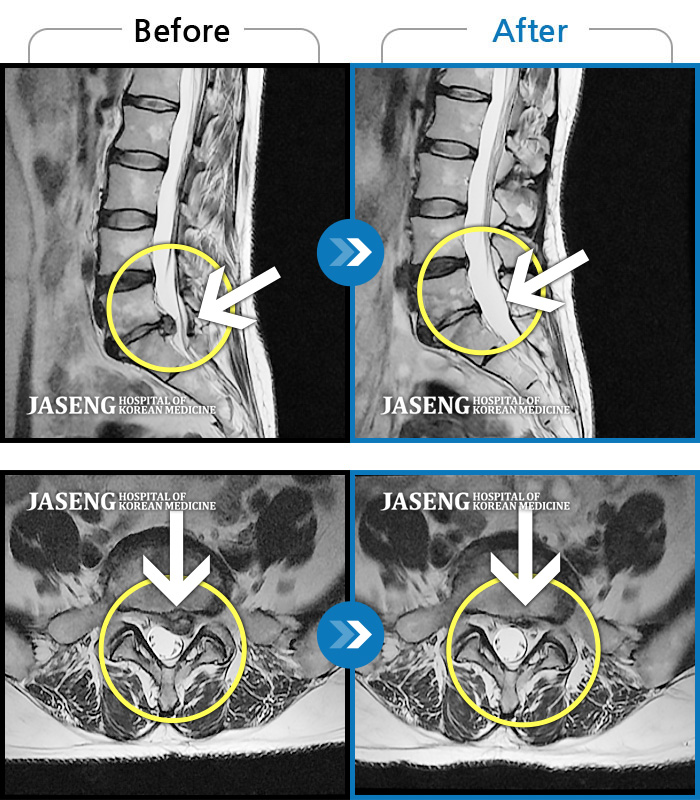 자생한방병원 치료사례 MRI로 보는 치료결과-허리 및 좌측 하지 통증