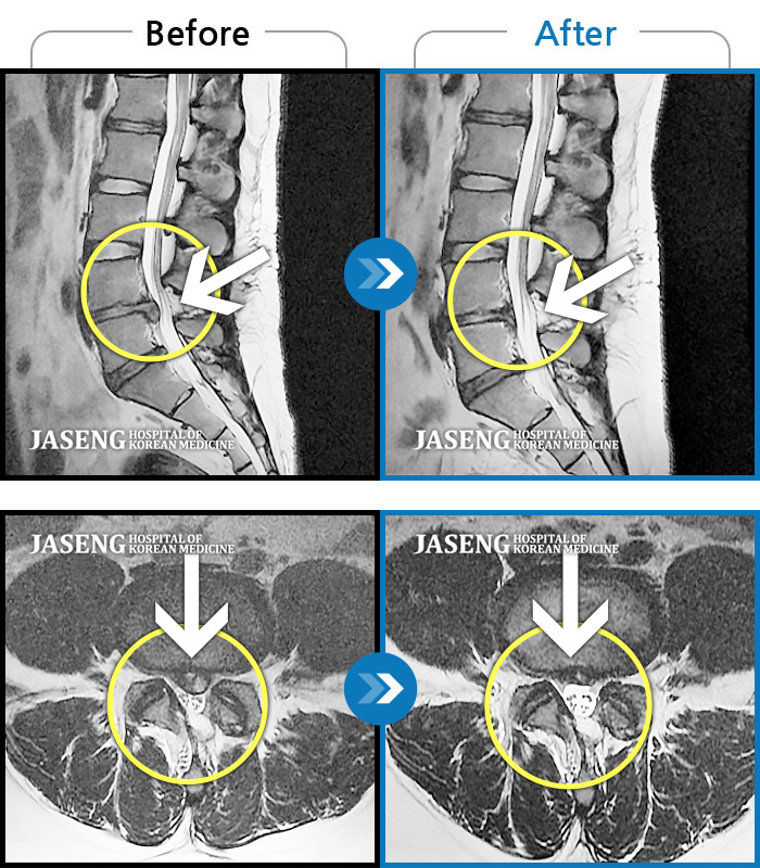 자생한방병원 치료사례 MRI로 보는 치료결과-허리 디스크 수술 후 재발된 디스크 환자
