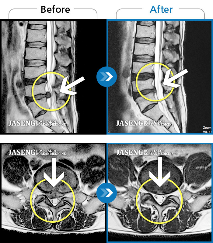 자생한방병원 치료사례 MRI로 보는 치료결과-좌측 엉치에서 발까지 당기는 통증
