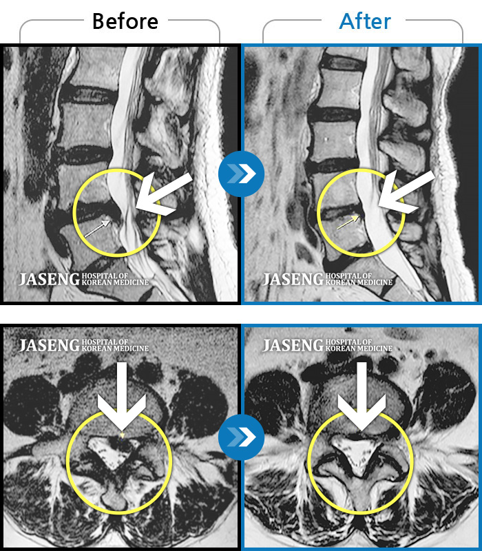 자생한방병원 치료사례 MRI로 보는 치료결과-거동이 불가하여 내원하였고 야간통, 하지방사통, 하지저림