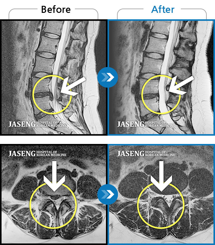 자생한방병원 치료사례 MRI로 보는 치료결과-요부 및 우하지 통증
