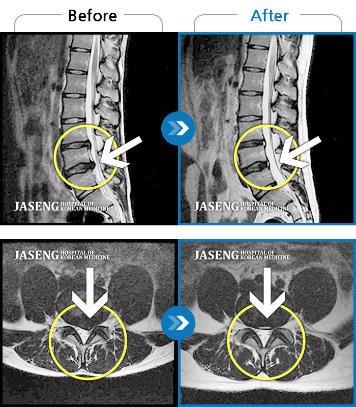 자생한방병원 치료사례 MRI로 보는 치료결과-좌측 허리 통증, 좌측 다리로 저린감, 당기는 통증