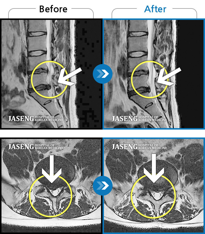 자생한방병원 치료사례 MRI로 보는 치료결과-허리 통증, 우측 하지 후면부터 발가락 전체에 저림 증상
