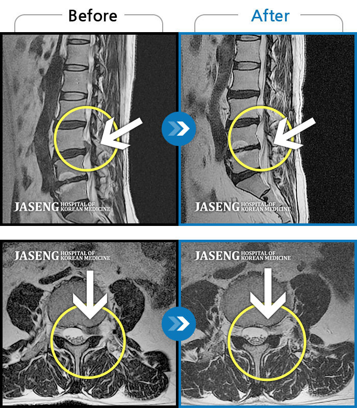 자생한방병원 치료사례 MRI로 보는 치료결과-서 있거나 보행시 엉덩이 통증