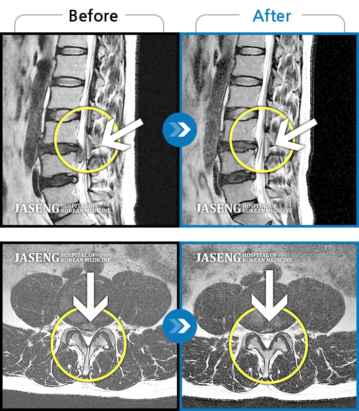 자생한방병원 치료사례 MRI로 보는 치료결과-허리 골반 통증, 앉을 때 우측 다리 당김 및 저린 증상